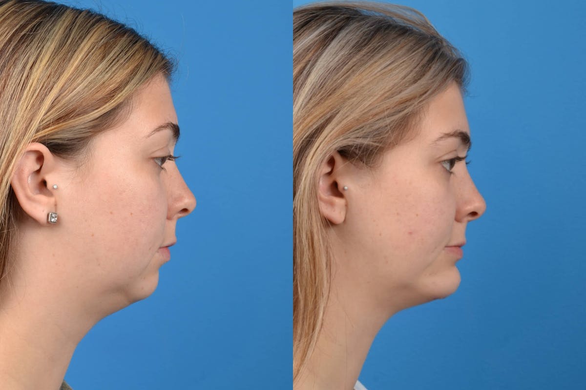 Chin Augmentation Before & After Gallery - Patient 122405498 - Image 5