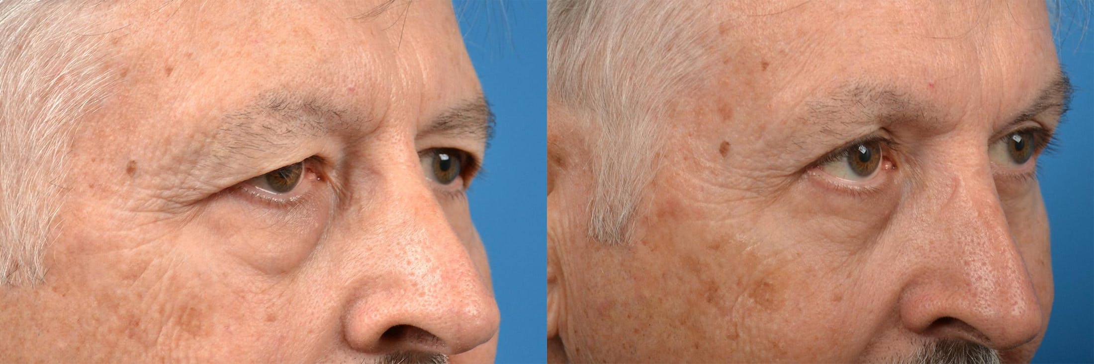 Brow Lift Before & After Gallery - Patient 122405499 - Image 7