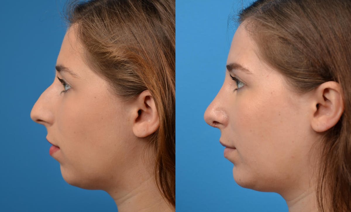 Chin Augmentation Before & After Gallery - Patient 122405502 - Image 1