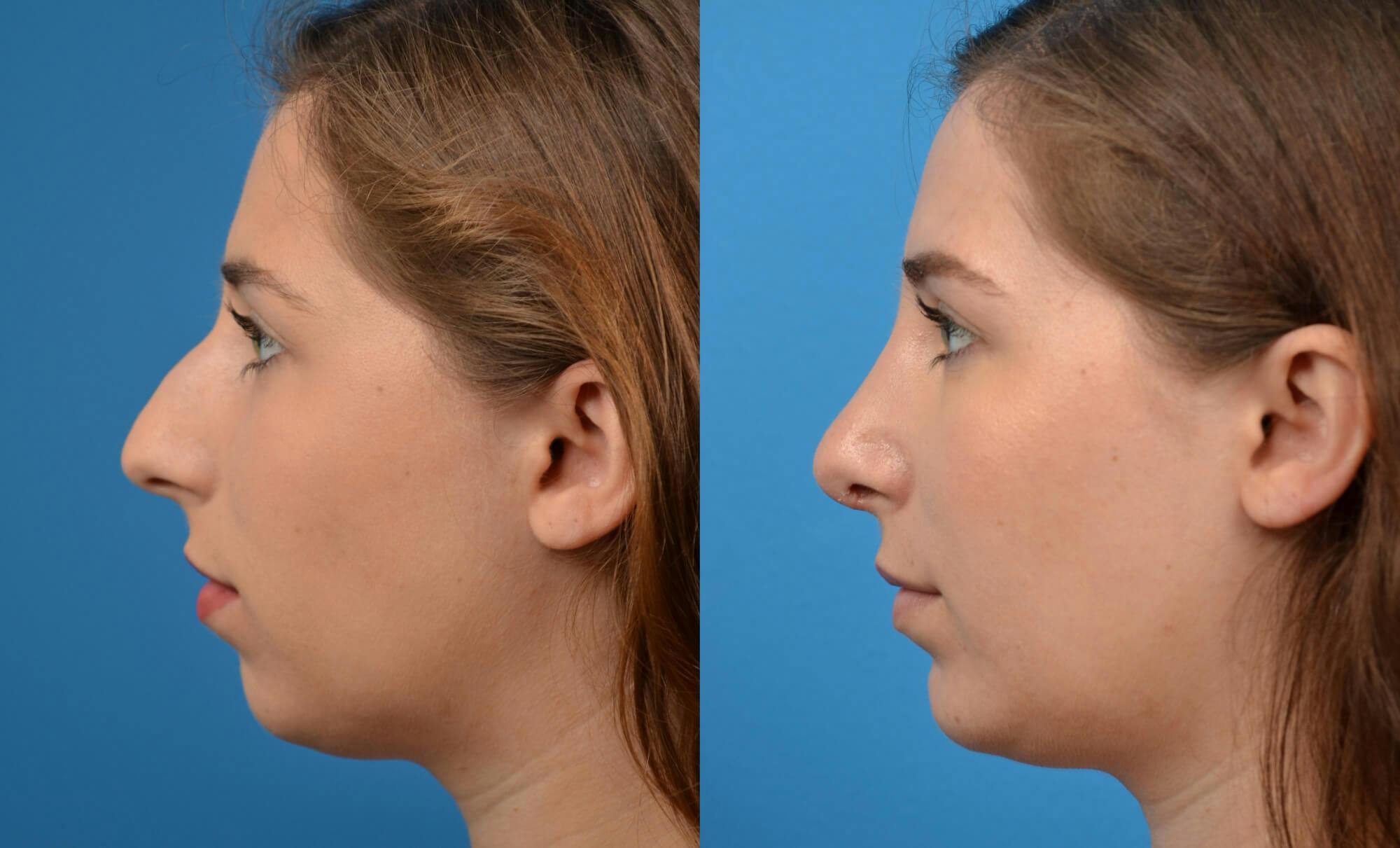 Chin Augmentation Before & After Gallery - Patient 122405502 - Image 1
