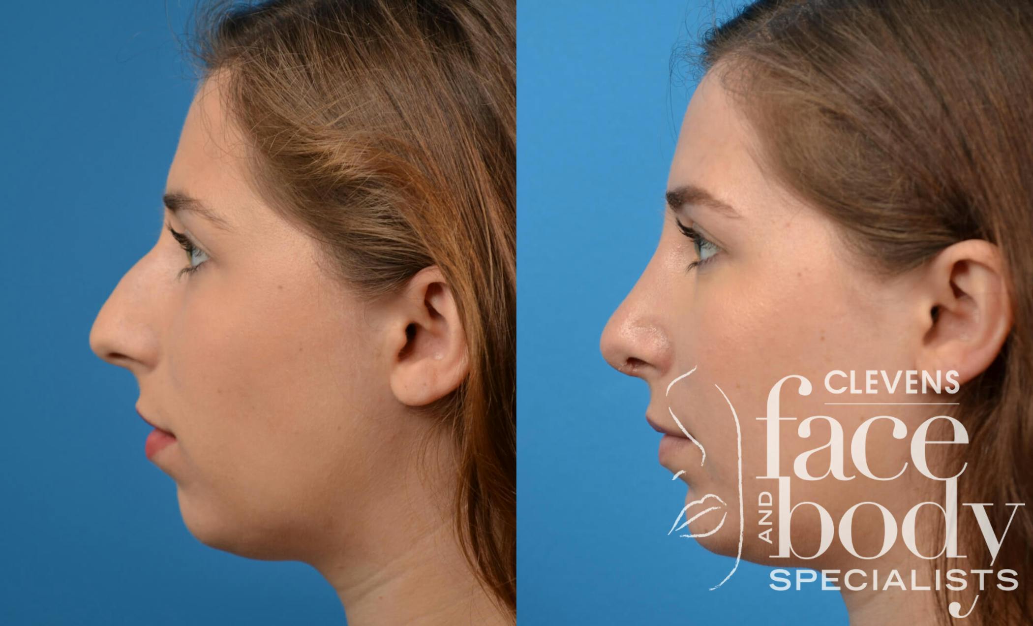 Chin Augmentation