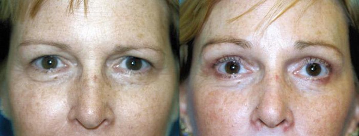 Brow Lift Before & After Gallery - Patient 122405500 - Image 1