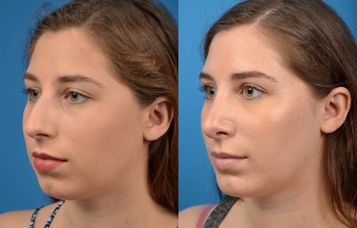 Chin Augmentation Before & After Gallery - Patient 122405502 - Image 2