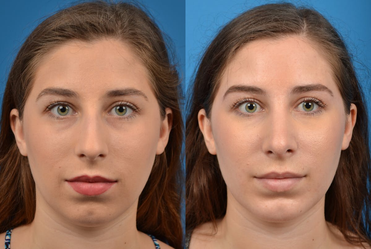 Chin Augmentation Before & After Gallery - Patient 122405502 - Image 3