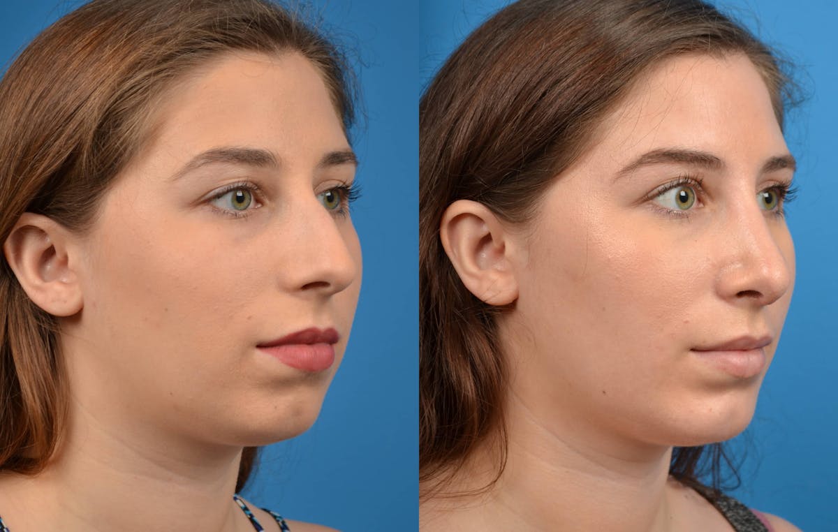 Chin Augmentation Before & After Gallery - Patient 122405502 - Image 4