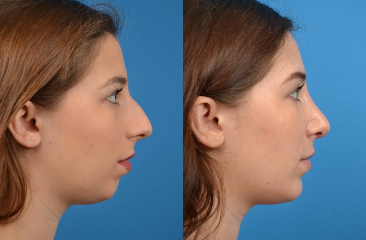 Chin Augmentation Before & After Gallery - Patient 122405502 - Image 5