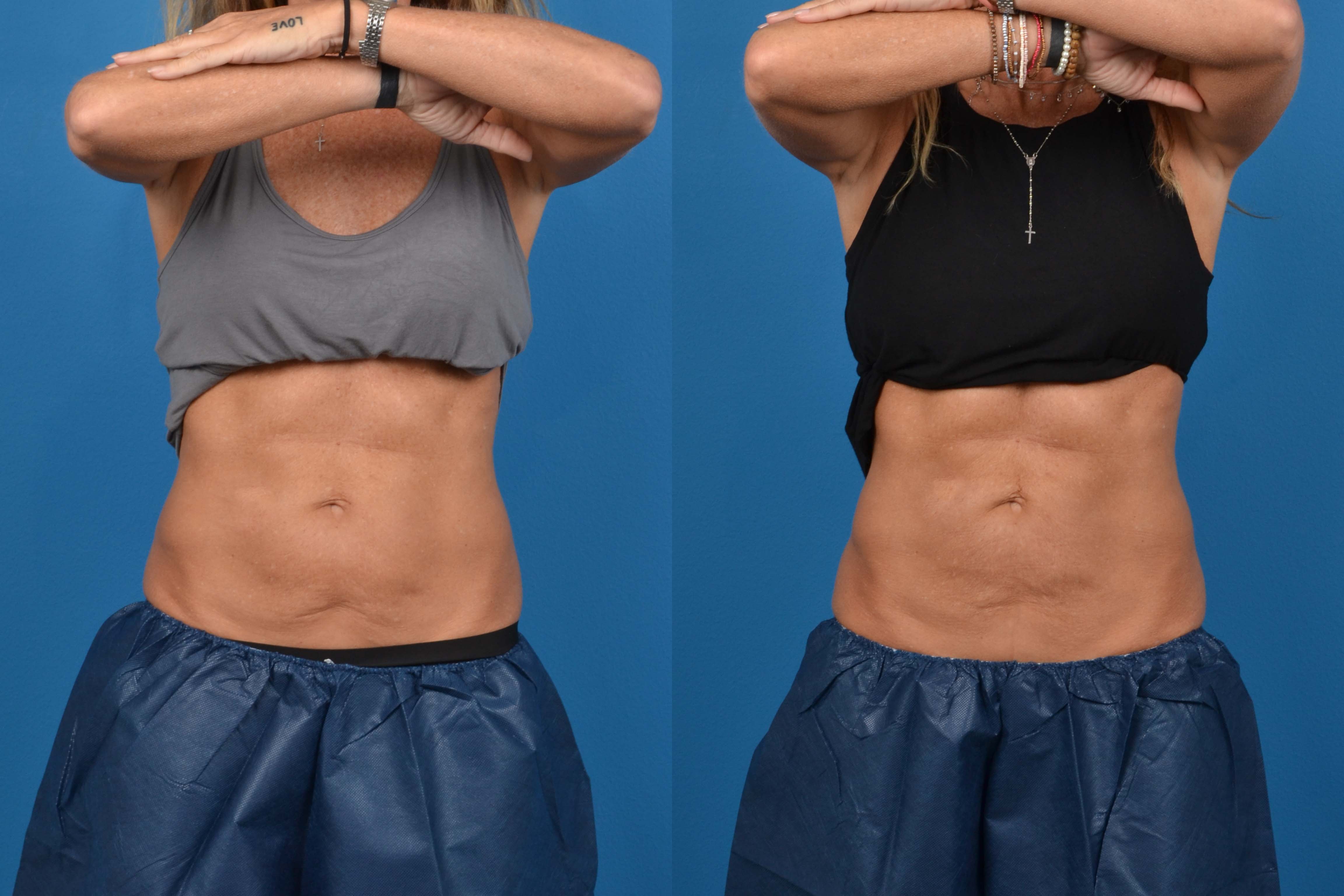 CoolSculpting Before & After Gallery - Patient 274067 - Image 1