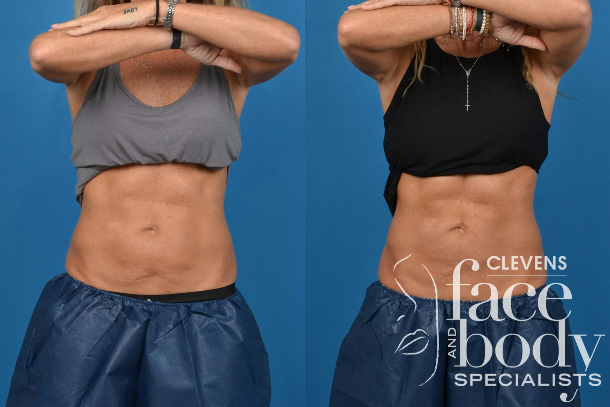 CoolSculpting ELITE