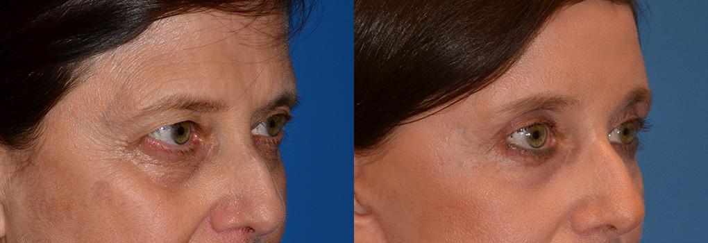 Brow Lift Before & After Gallery - Patient 122405503 - Image 1