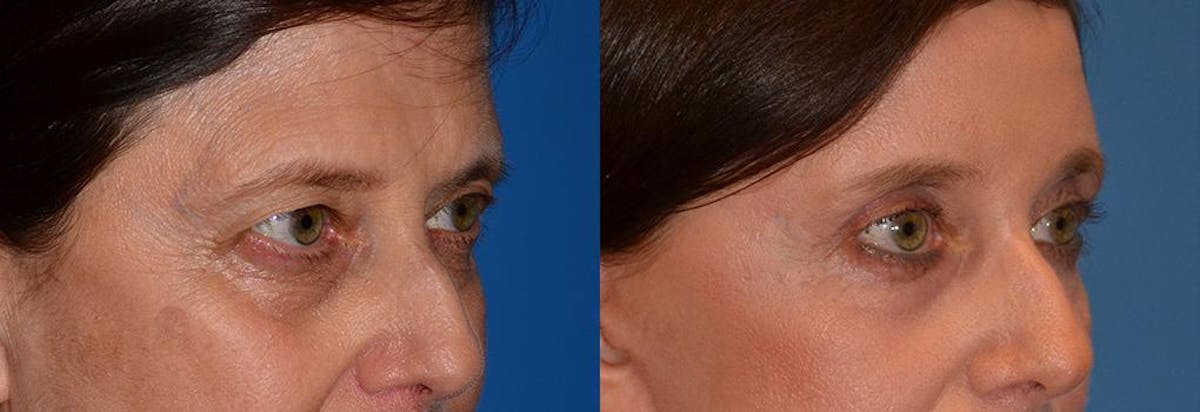 Brow Lift Before & After Gallery - Patient 122405503 - Image 1