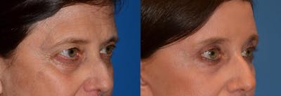 Brow Lift Before & After Gallery - Patient 122405503 - Image 1