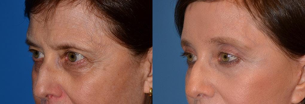 Brow Lift Before & After Gallery - Patient 122405503 - Image 2