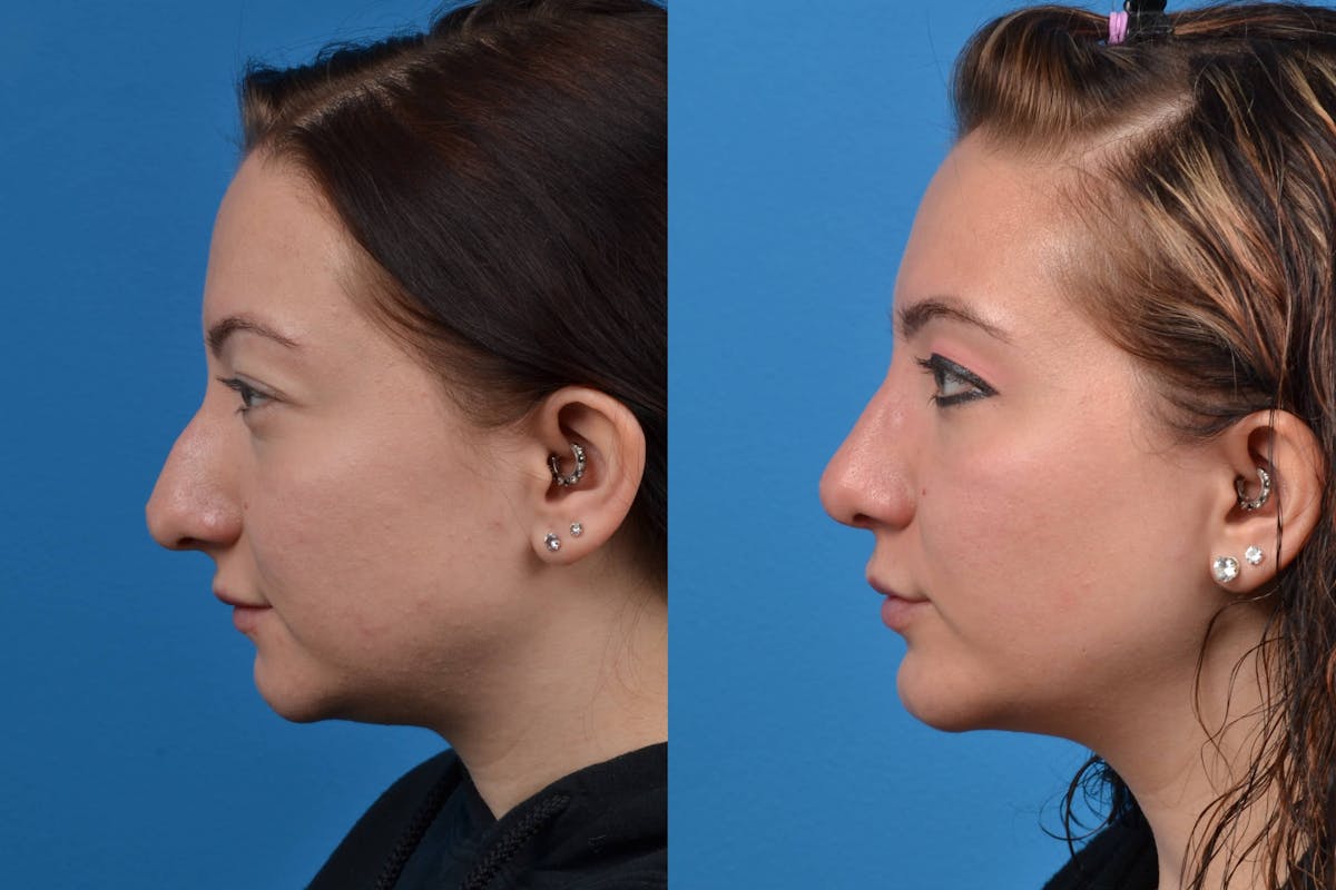 Chin Augmentation Before & After Gallery - Patient 122405507 - Image 1