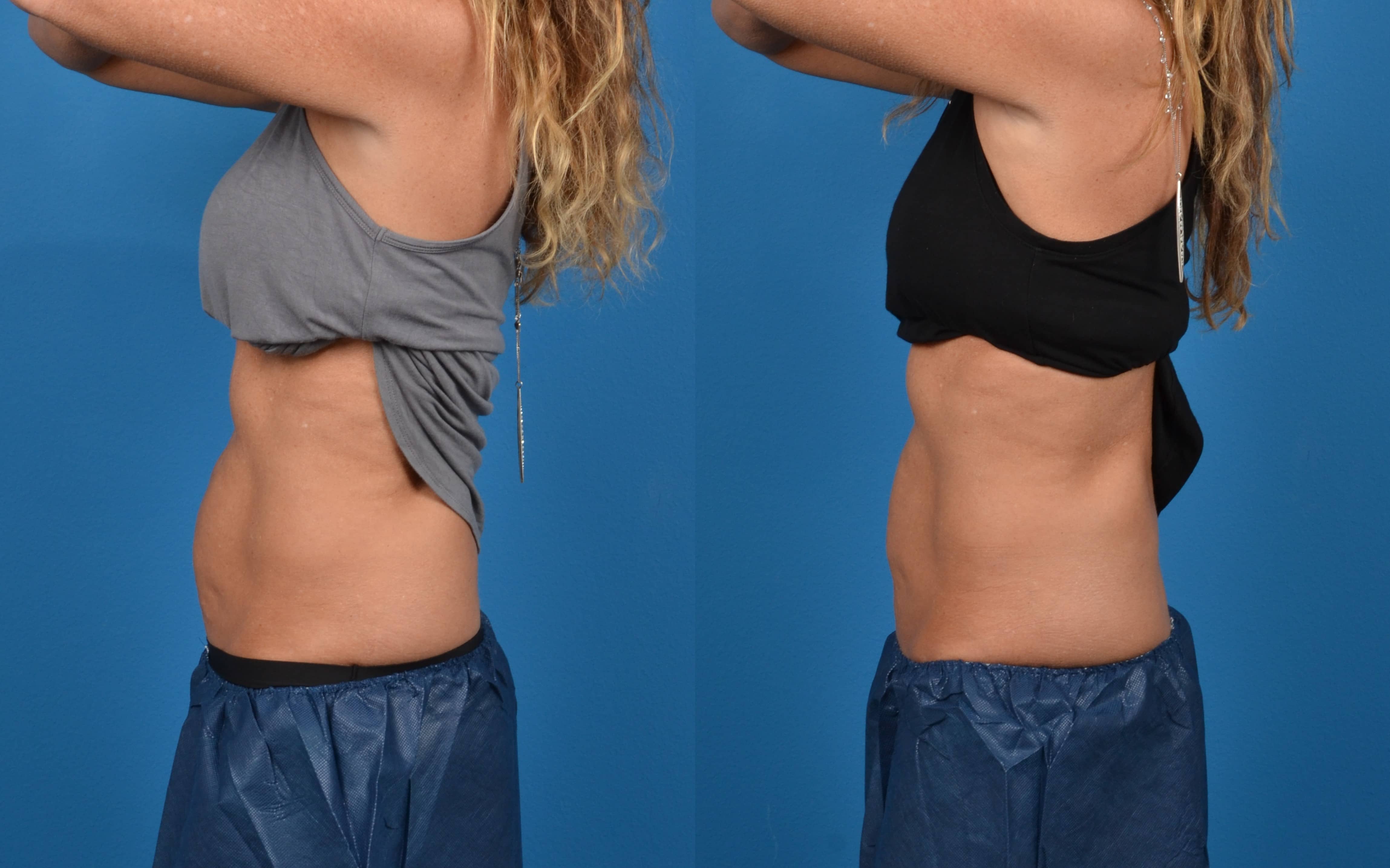 CoolSculpting Before & After Gallery - Patient 274067 - Image 2