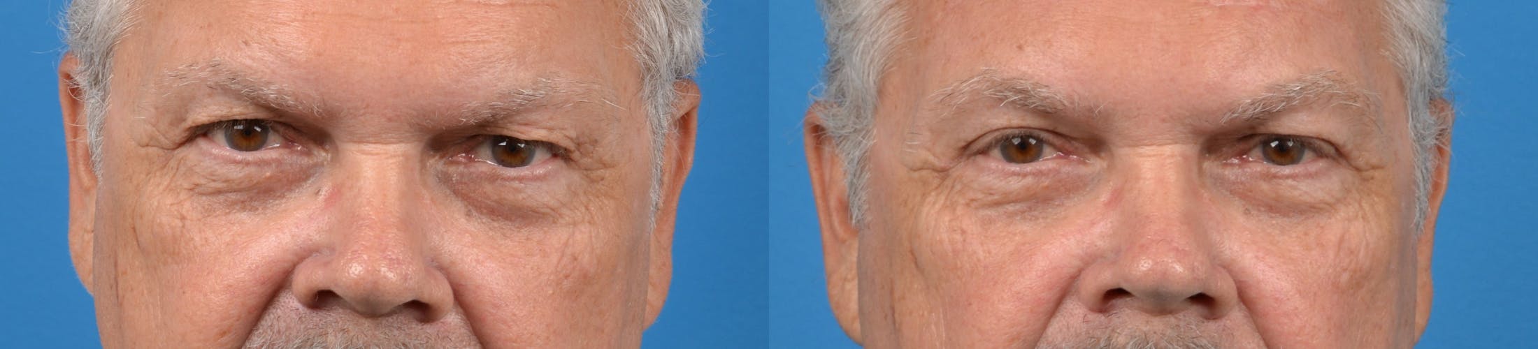 Brow Lift Before & After Gallery - Patient 122405505 - Image 1