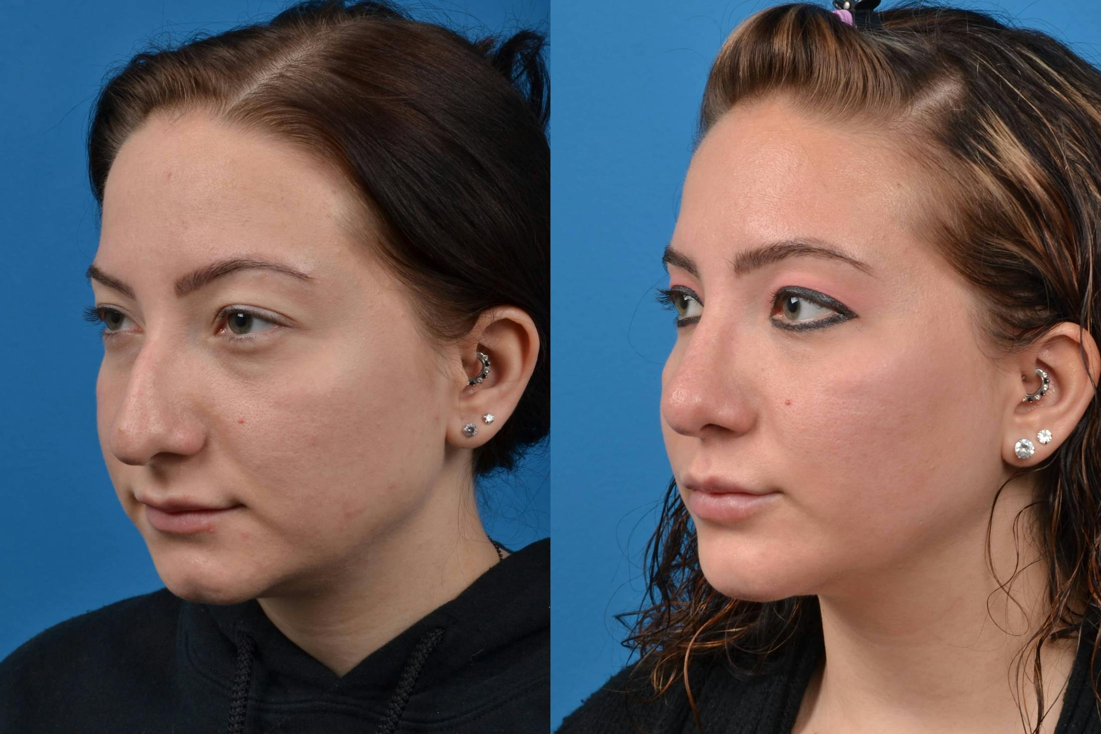Chin Augmentation Before & After Gallery - Patient 122405507 - Image 2