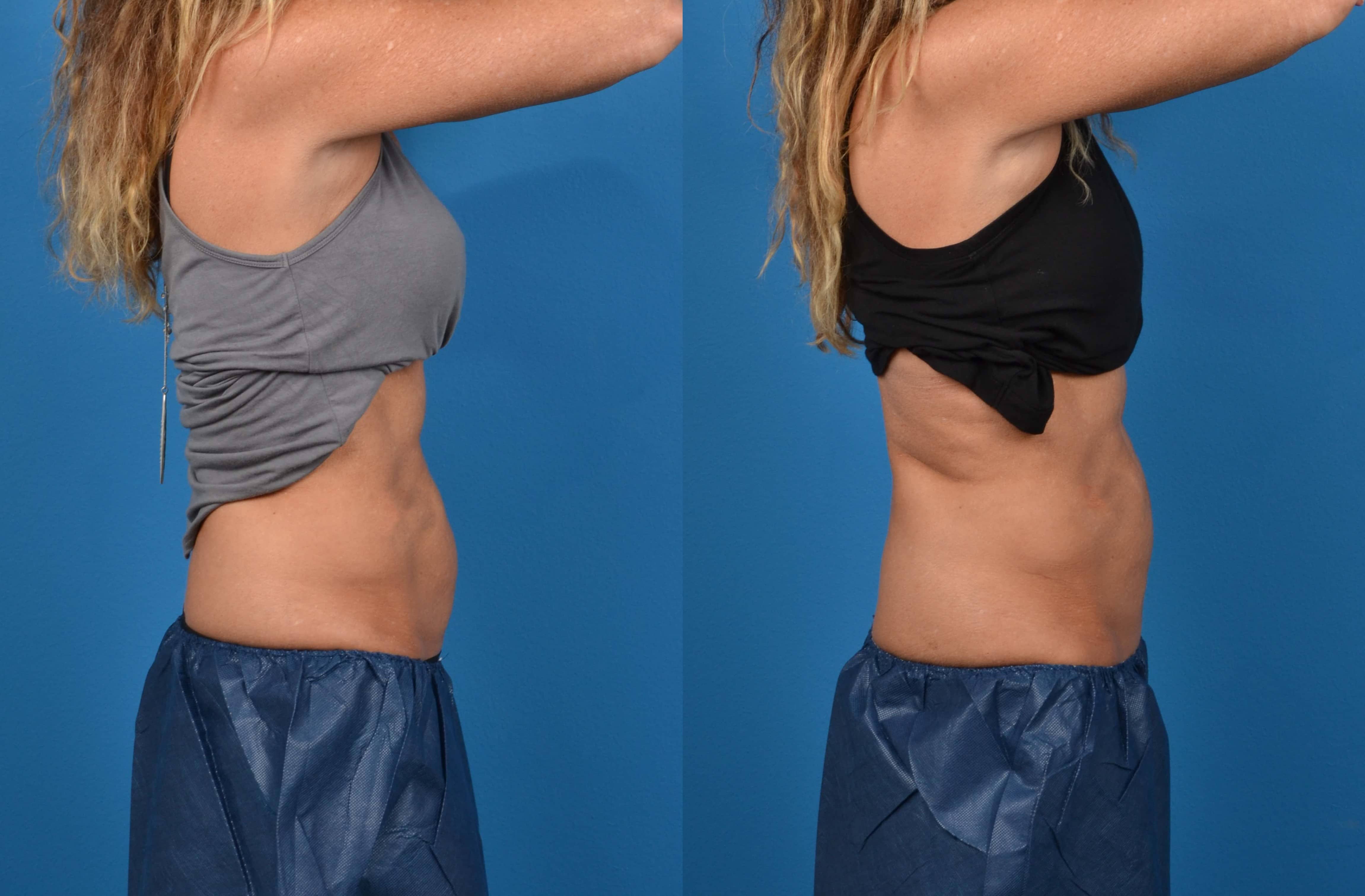 CoolSculpting Before & After Gallery - Patient 274067 - Image 3