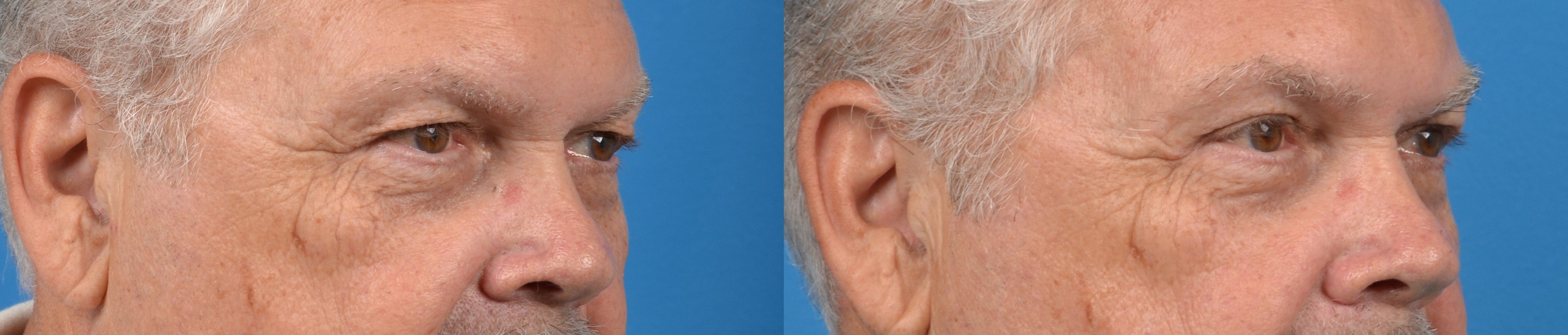 Brow Lift Before & After Gallery - Patient 122405505 - Image 2