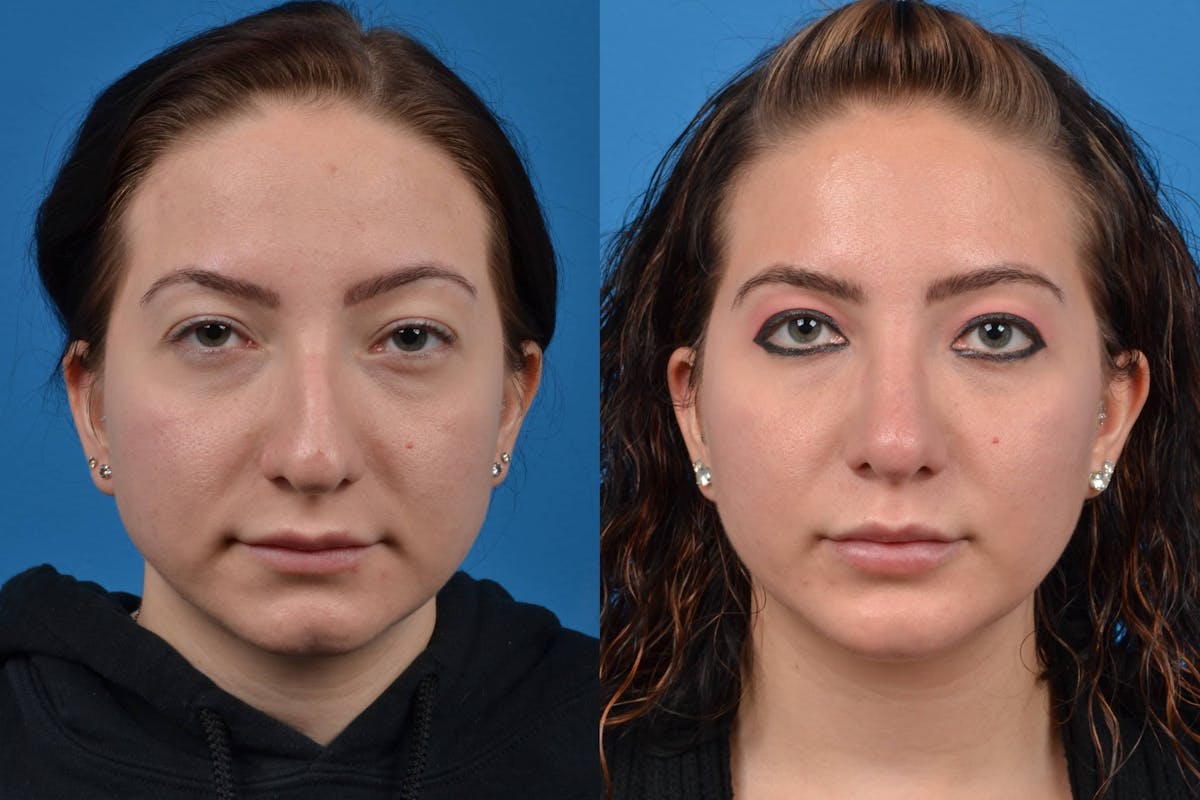 Chin Augmentation Before & After Gallery - Patient 122405507 - Image 3