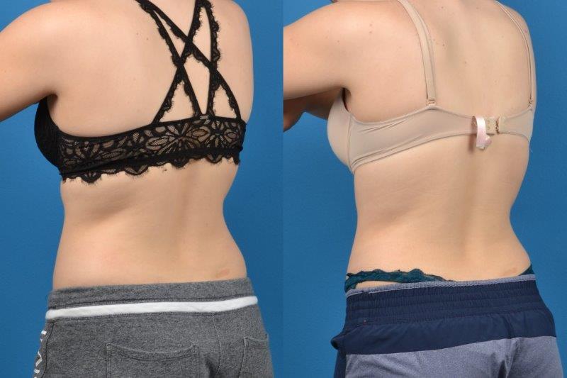 CoolSculpting Before & After Gallery - Patient 537858 - Image 1