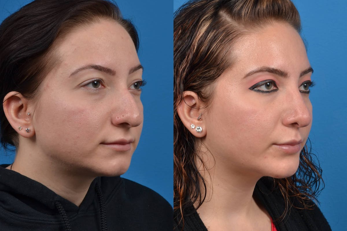 Chin Augmentation Before & After Gallery - Patient 122405507 - Image 4