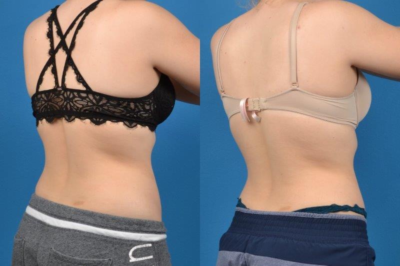CoolSculpting Before & After Gallery - Patient 537858 - Image 2