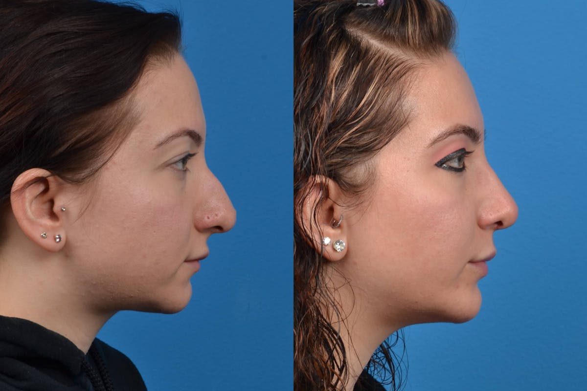 Chin Augmentation Before & After Gallery - Patient 122405507 - Image 5