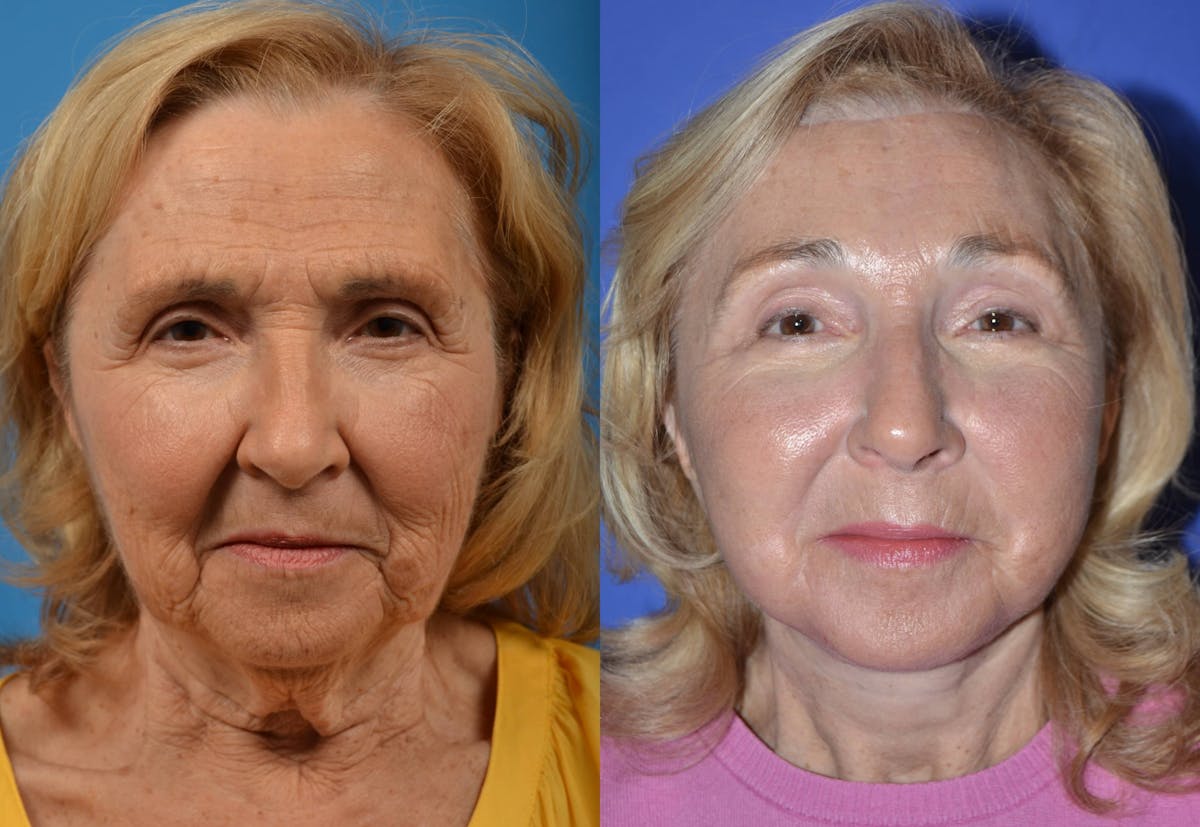 Brow Lift Before & After Gallery - Patient 122405515 - Image 1