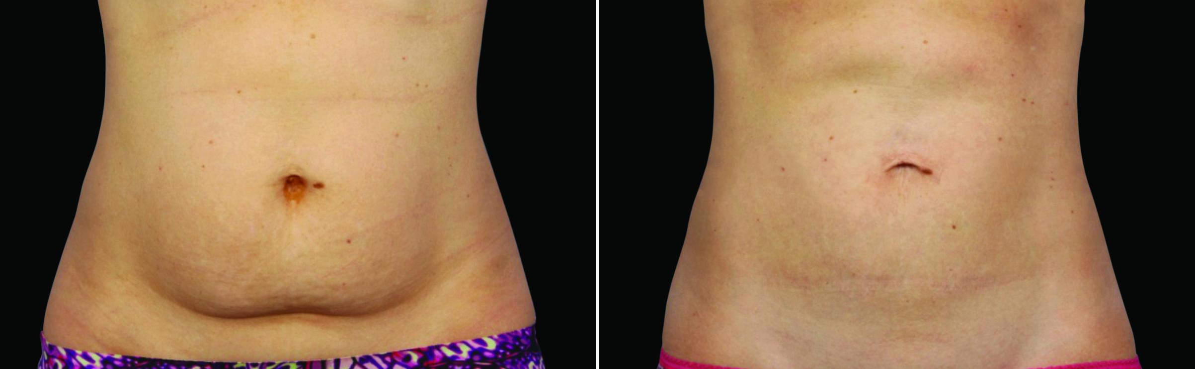 CoolSculpting Before & After Gallery - Patient 262162 - Image 1