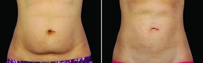 CoolSculpting Before & After Gallery - Patient 122405508 - Image 1
