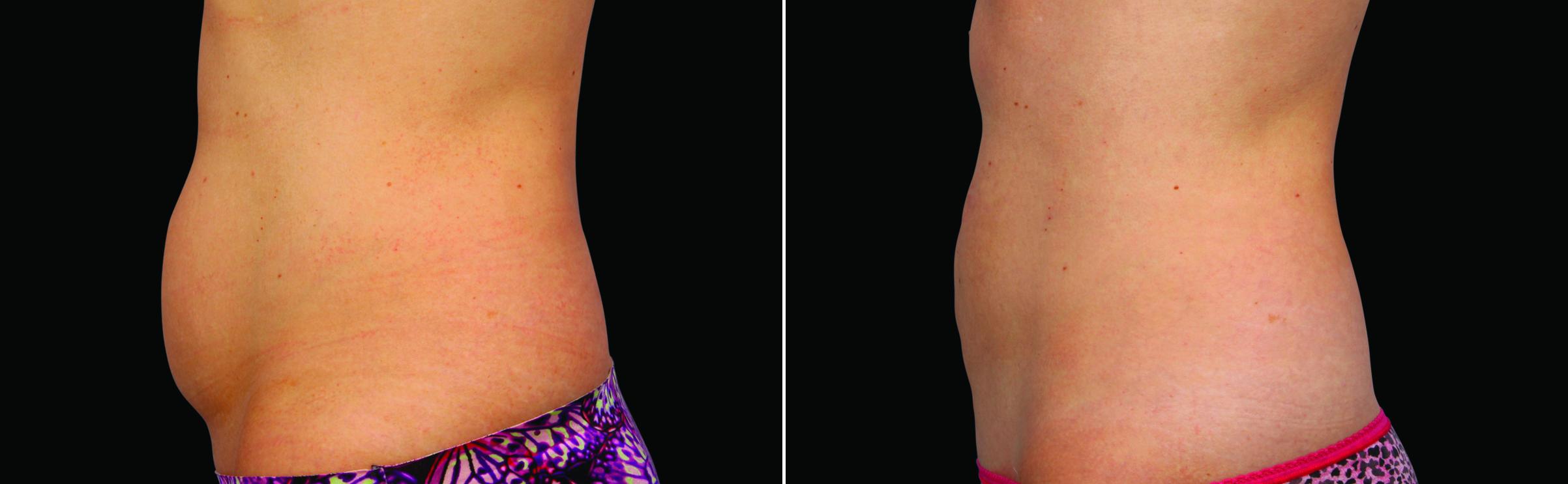 CoolSculpting Before & After Gallery - Patient 262162 - Image 2