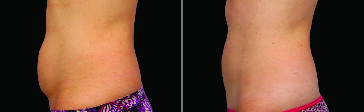 CoolSculpting Before & After Gallery - Patient 122405508 - Image 2
