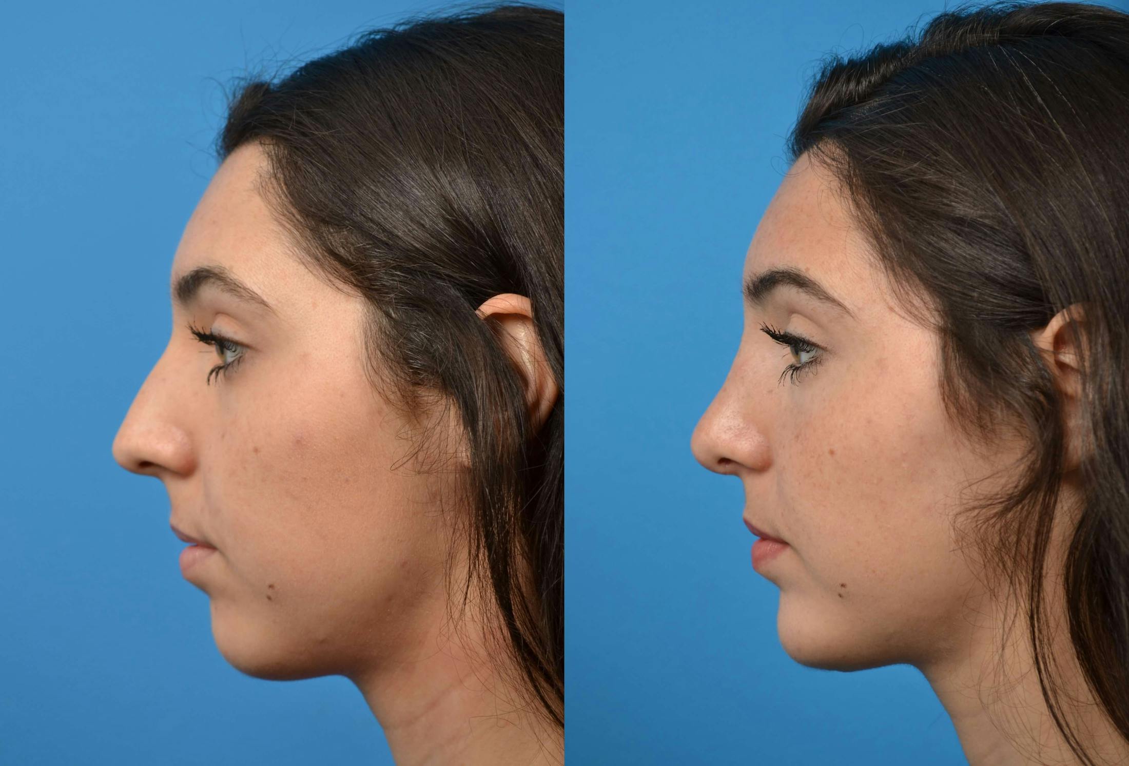 Chin Augmentation Before & After Gallery - Patient 122405516 - Image 1