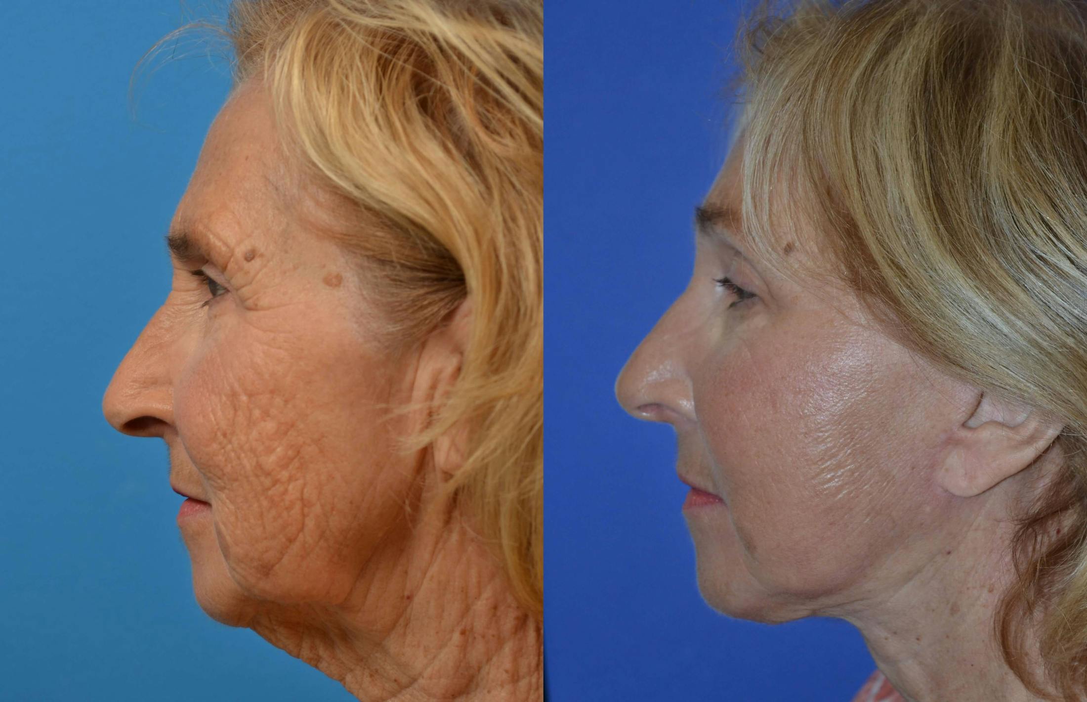 Brow Lift Before & After Gallery - Patient 122405515 - Image 2