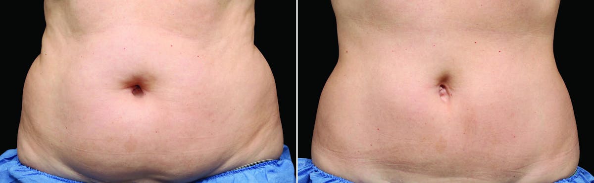 CoolSculpting Before & After Gallery - Patient 122405510 - Image 1