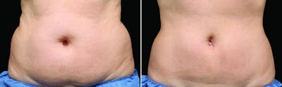 CoolSculpting Before & After Gallery - Patient 122405510 - Image 1