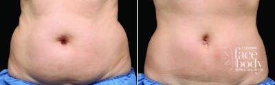 CoolSculpting Before & After Gallery - Patient 261561 - Image 1