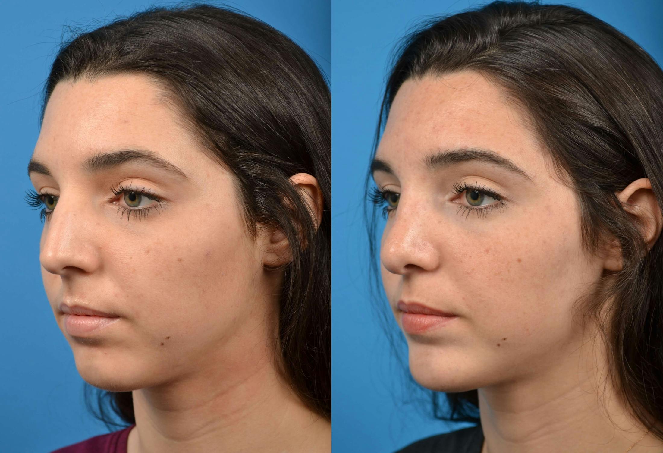 Chin Augmentation Before & After Gallery - Patient 122405516 - Image 2