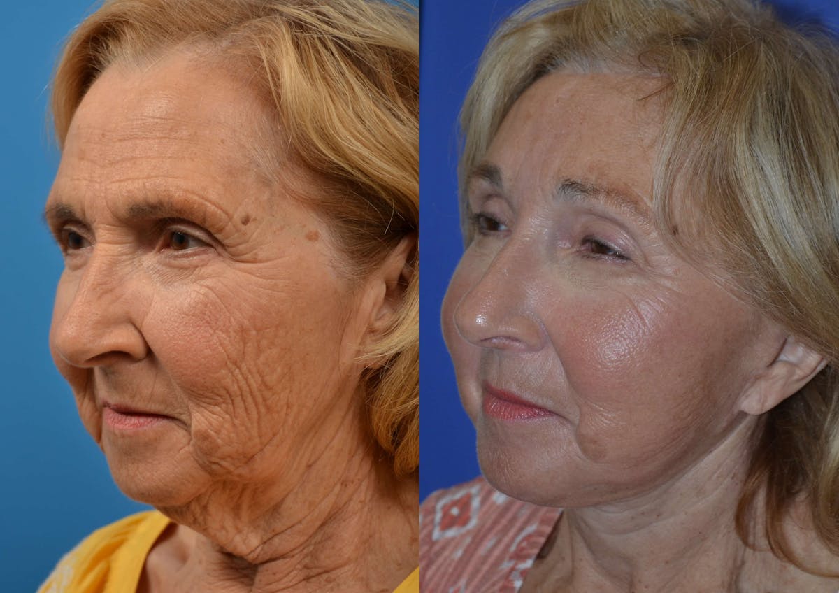 Brow Lift Before & After Gallery - Patient 122405515 - Image 3