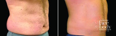 CoolSculpting Before & After Gallery - Patient 182592 - Image 1