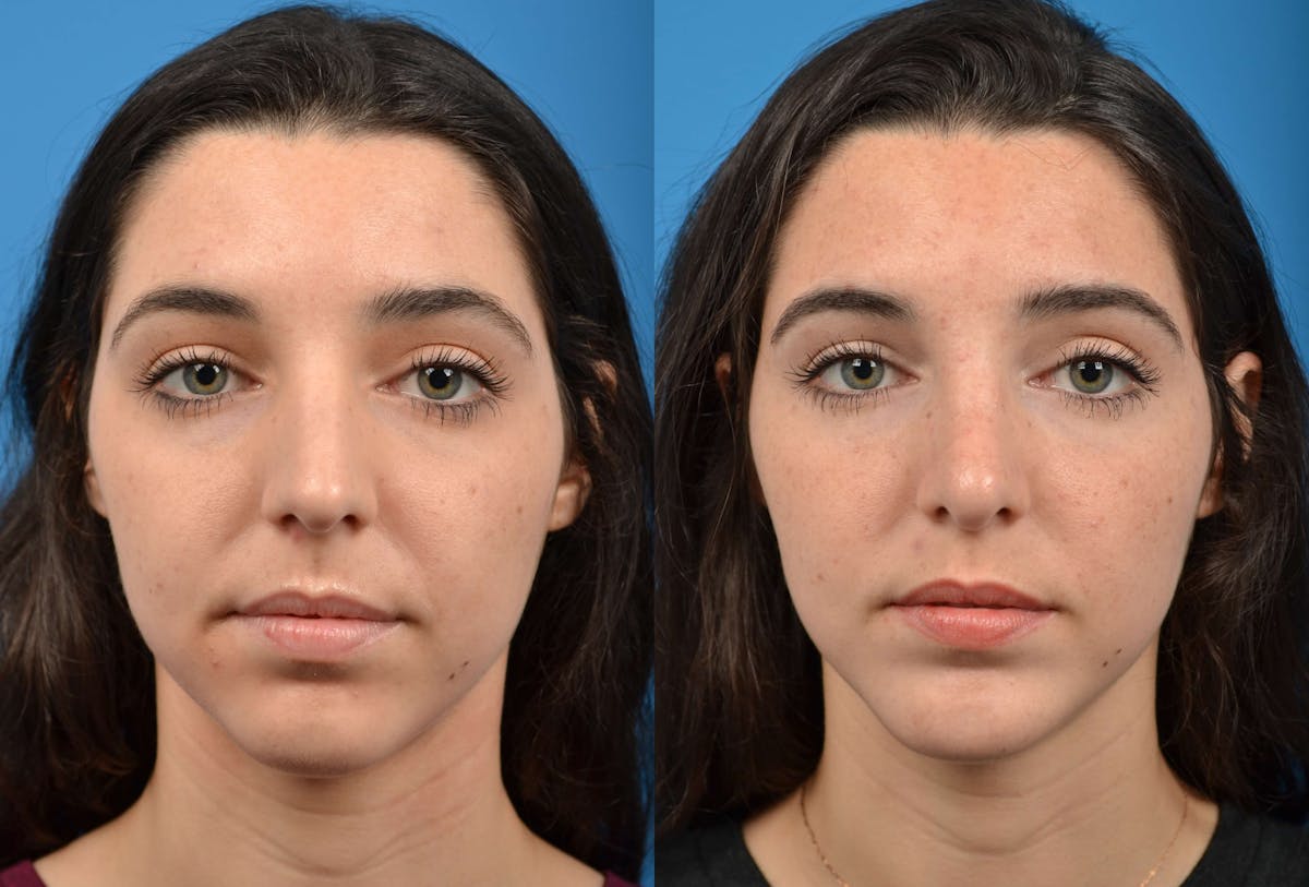 Chin Augmentation Before & After Gallery - Patient 122405516 - Image 3