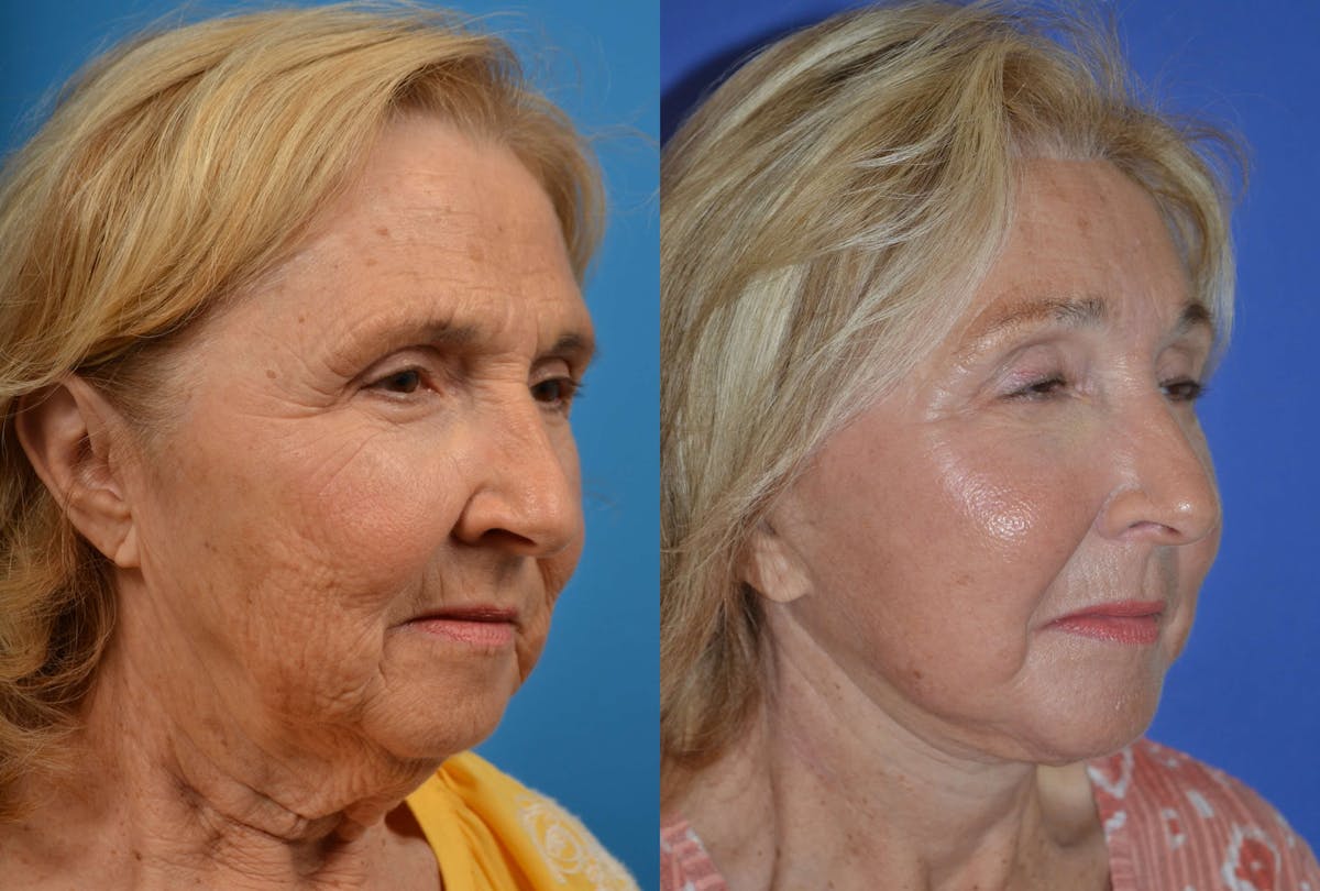 Brow Lift Before & After Gallery - Patient 122405515 - Image 4