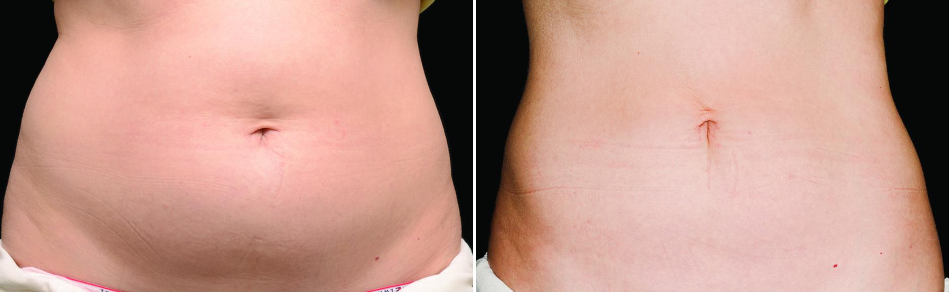 CoolSculpting Before & After Gallery - Patient 342590 - Image 1