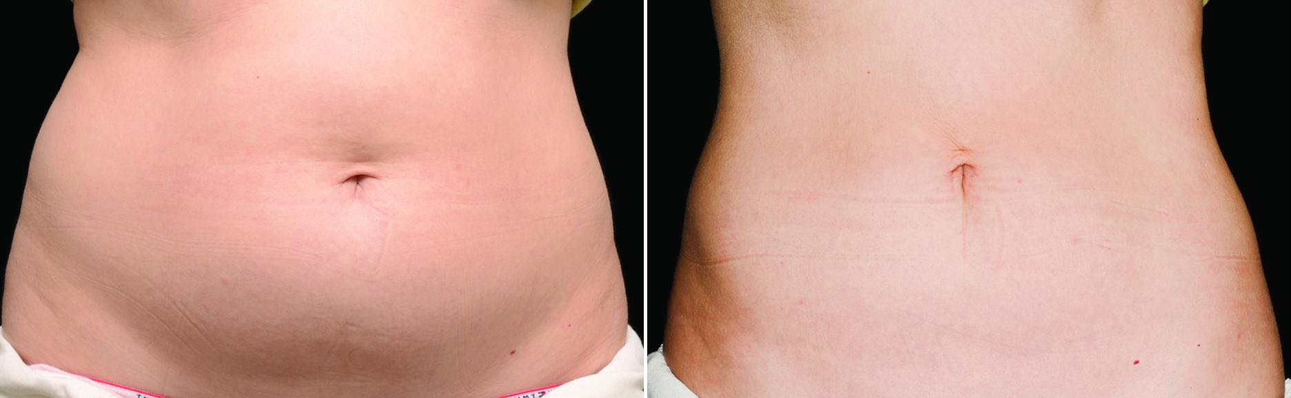CoolSculpting Before & After Gallery - Patient 122405512 - Image 1