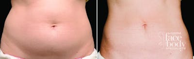 CoolSculpting Before & After Gallery - Patient 342590 - Image 1