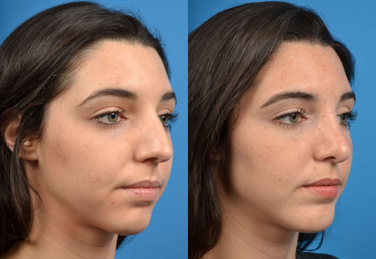 Chin Augmentation Before & After Gallery - Patient 122405516 - Image 4
