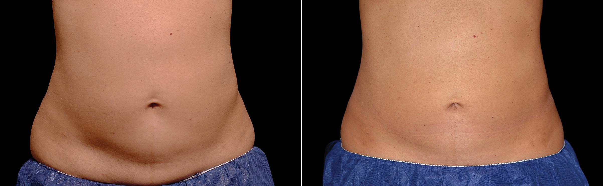 CoolSculpting Before & After Gallery - Patient 719104 - Image 1