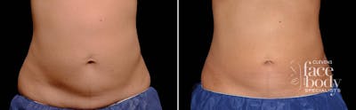 CoolSculpting Before & After Gallery - Patient 719104 - Image 1