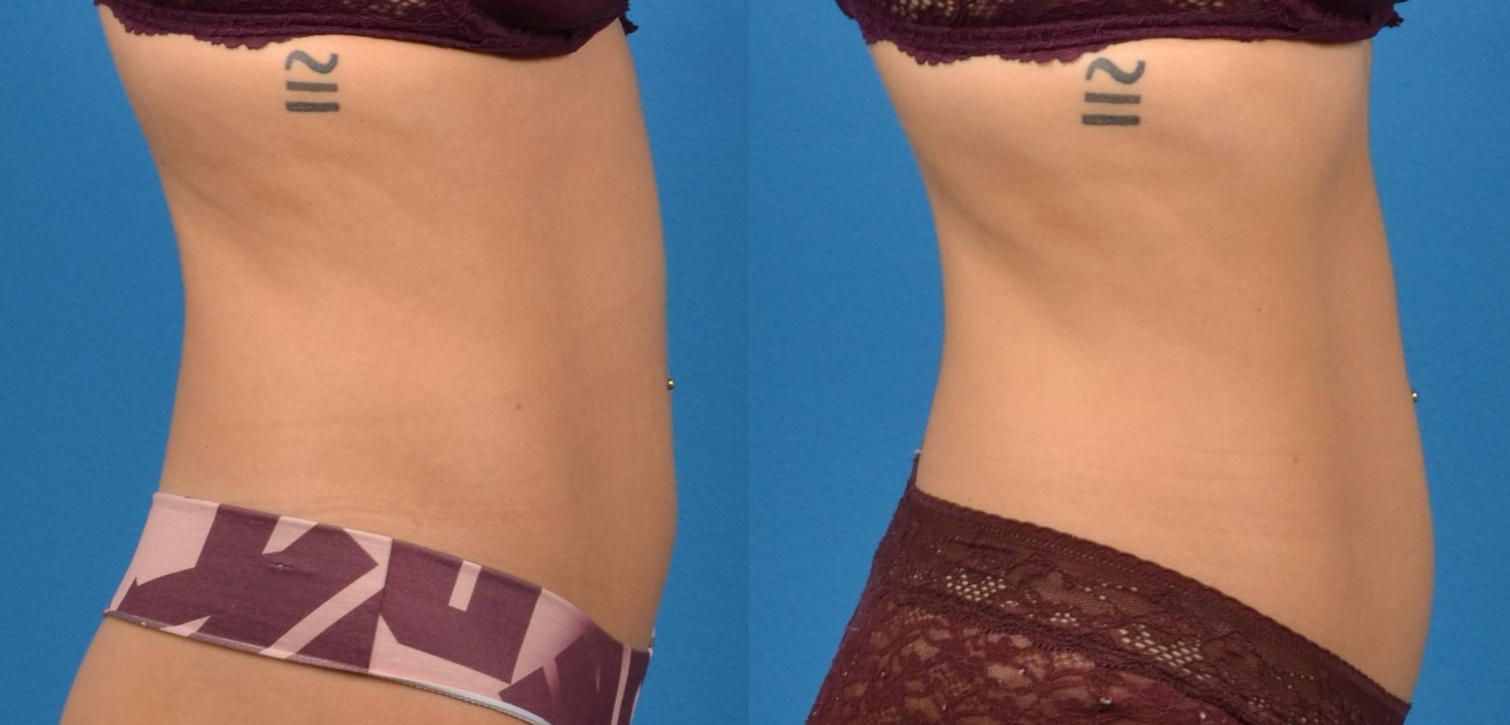 CoolTone Before & After Gallery - Patient 122405514 - Image 4