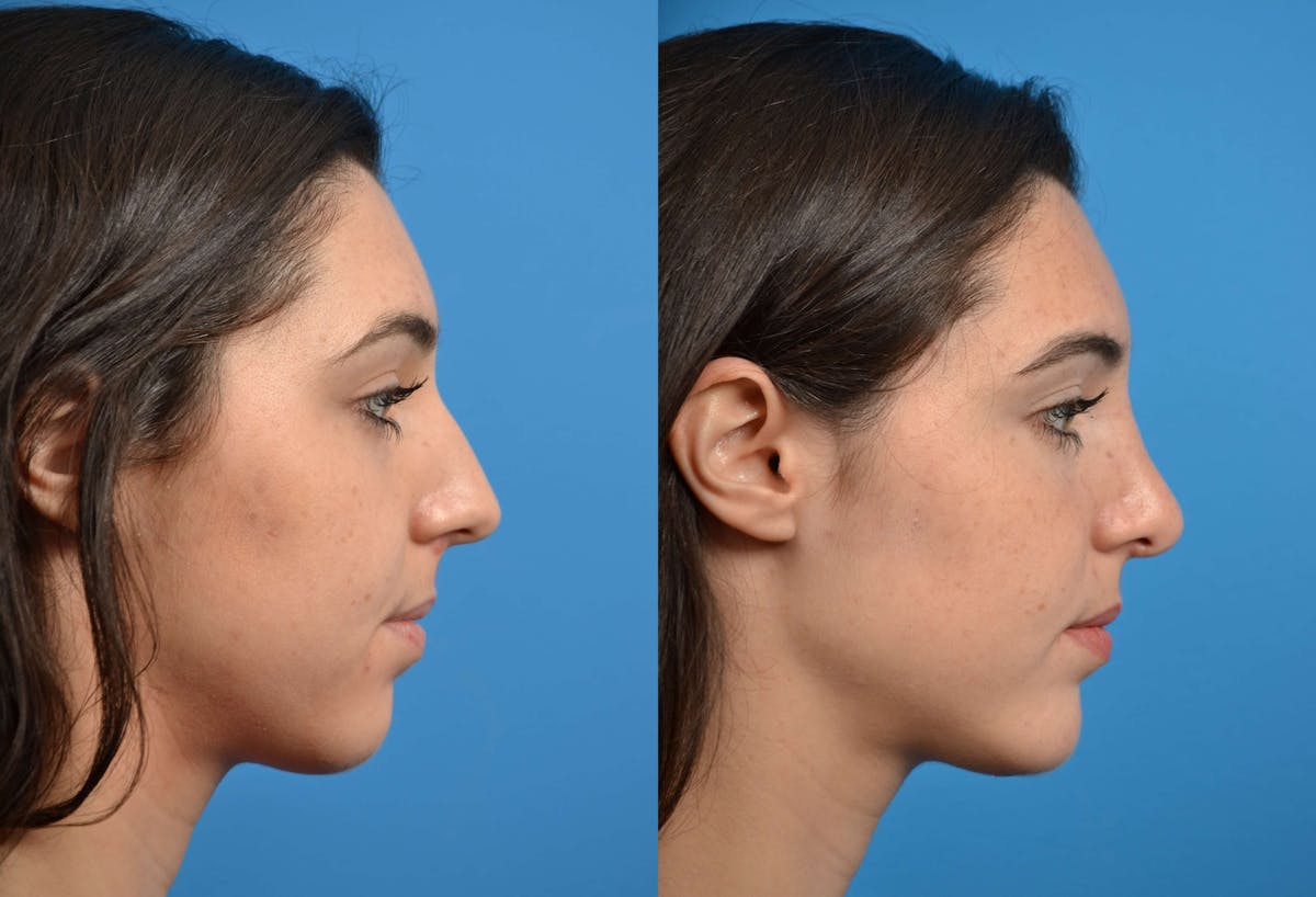Chin Augmentation Before & After Gallery - Patient 122405516 - Image 5